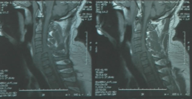 颈5-6椎体严重错位致颈椎管狭窄症诊断图片